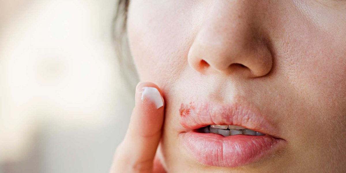 Lion Pharmacy herpes lizence AdobeStock_219774827